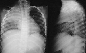 Viêm phế quản phổi không đặc hiệu
