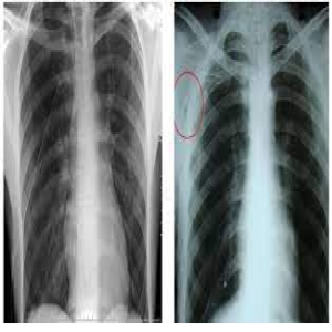hình ảnh chụp x quang phổi
